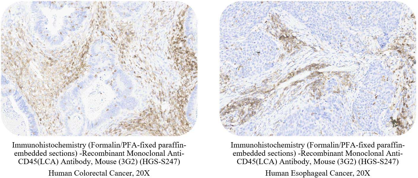 CD45 (LCA) CANCER SAMPLE