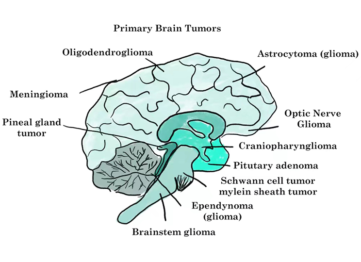 不同类型的脑肿瘤